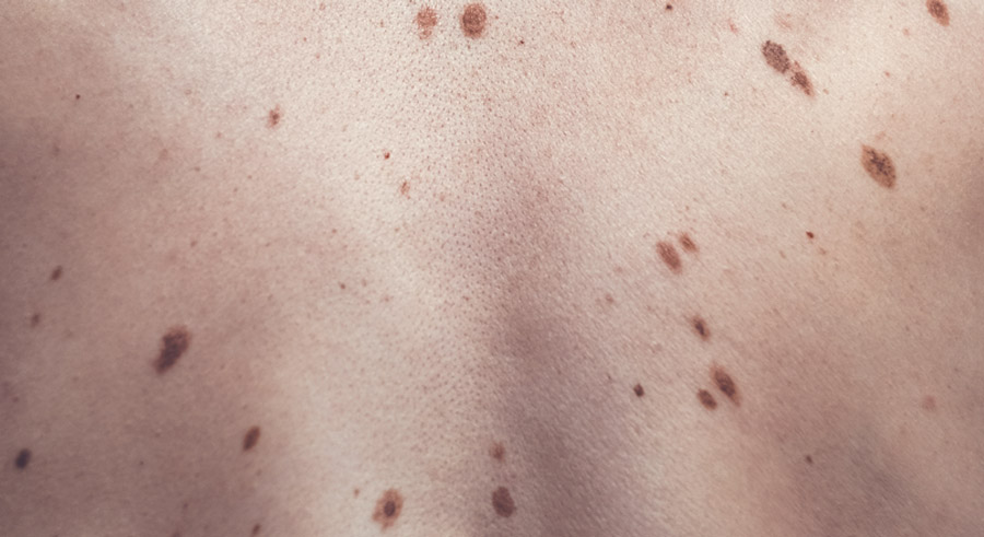 Atypical Nevus