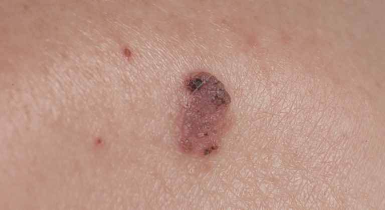 Squamous Cell Carcinoma – KorPath
