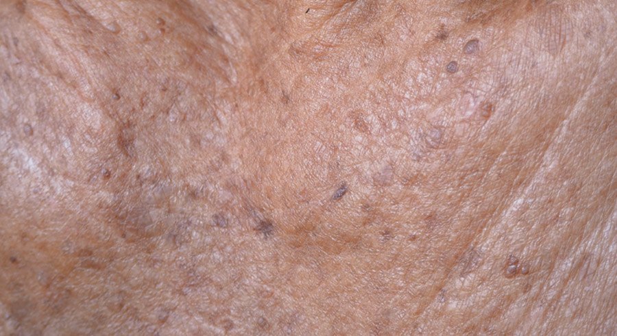 Seborrheic Keratosis